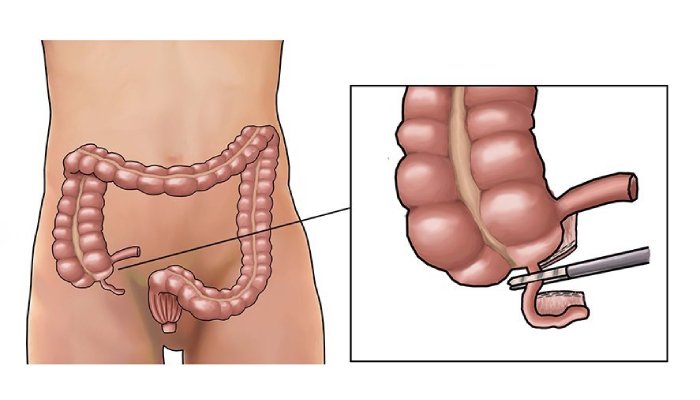 Appendix Surgery in Whitefield