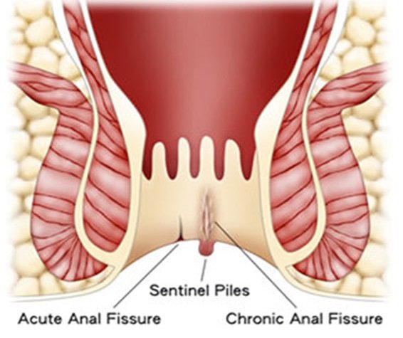 Anal Fissure Surgery in whitefield