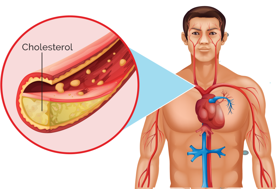 Cholesterol Disorders Treatment in Whitefield