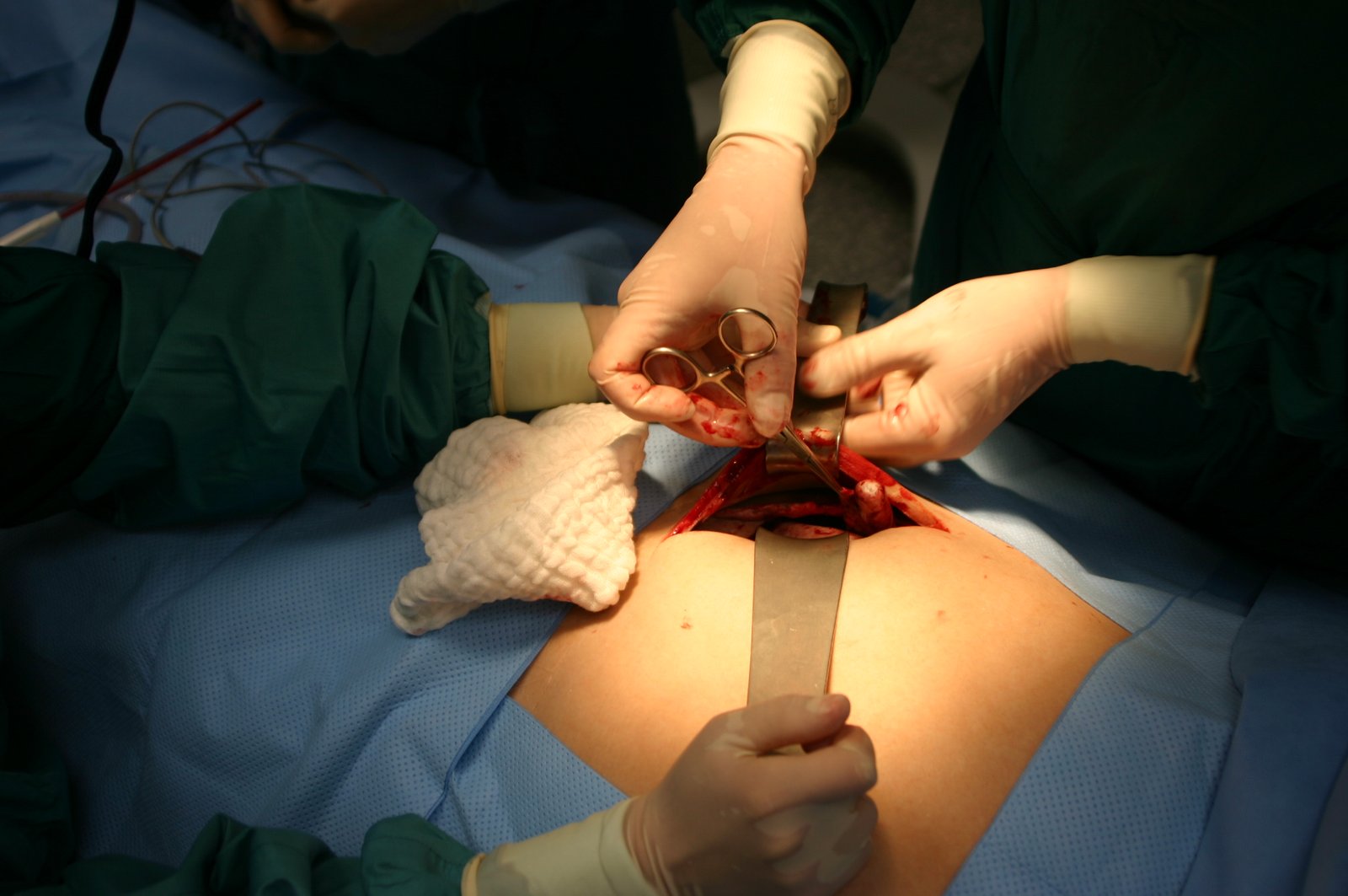 appendectomy